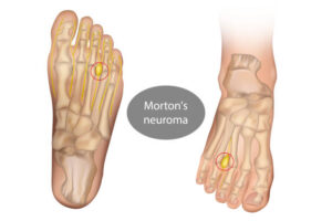 Syndrome de Morton